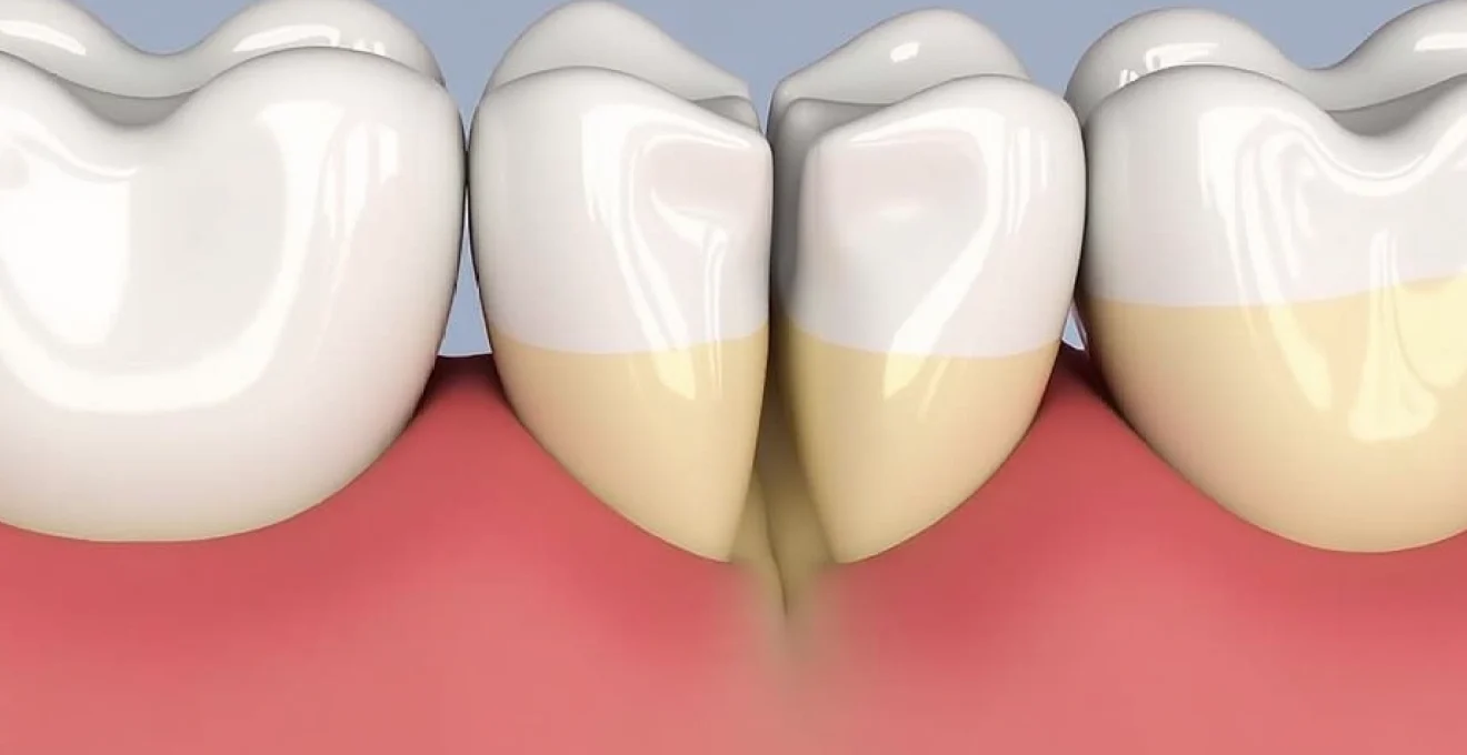 why-bottom-front-teeth-wear-down