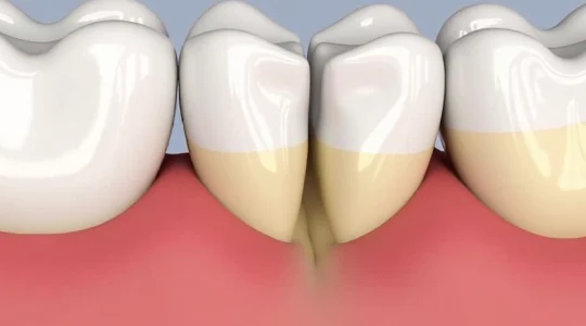 why-bottom-front-teeth-wear-down